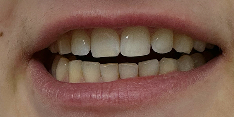 Sourire après un traitement esthétique